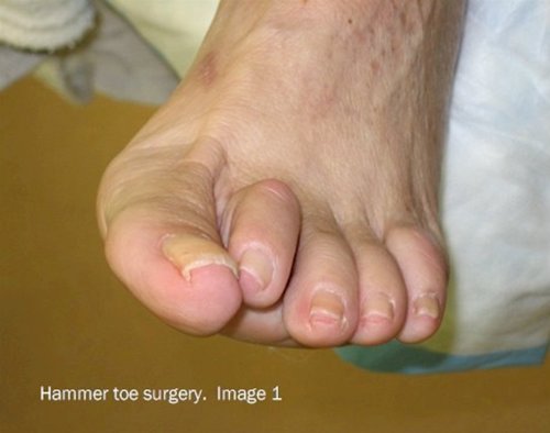 Hammer Toes Causes And Treatment Options